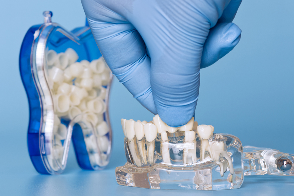 Dental crowns & bridges comparison with implants at St. Jacobs Dental Caree