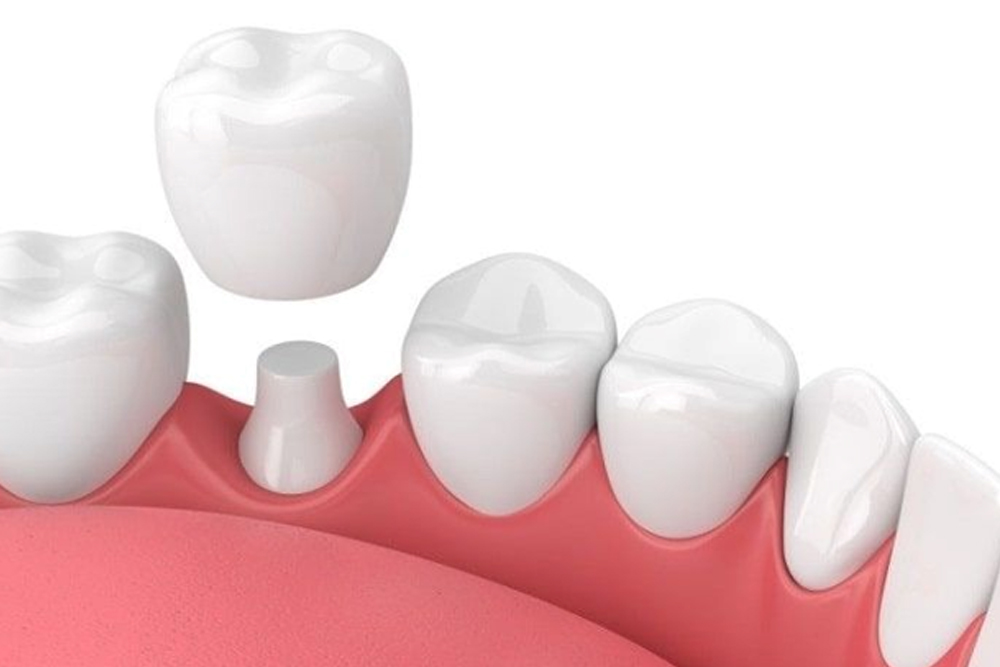 What to do when a crown comes loose