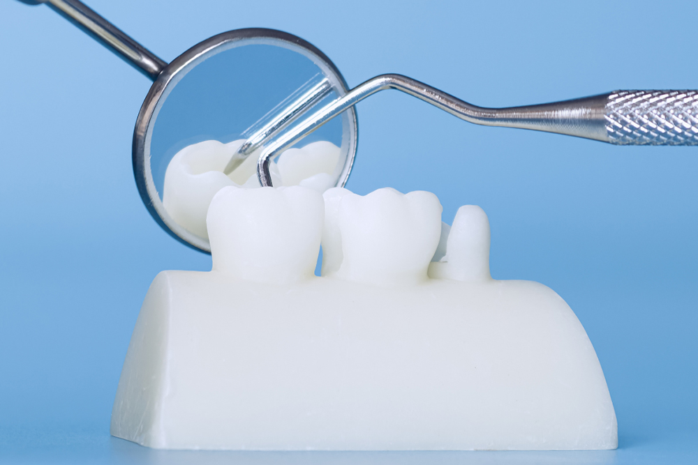 Restorative dentistry in St. Jacobs minimally invasive treatment at St. Jacobs Dental Care